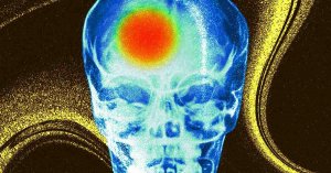 Extreme Temperatures Tied to Over Half a Million Stroke Deaths in 2023